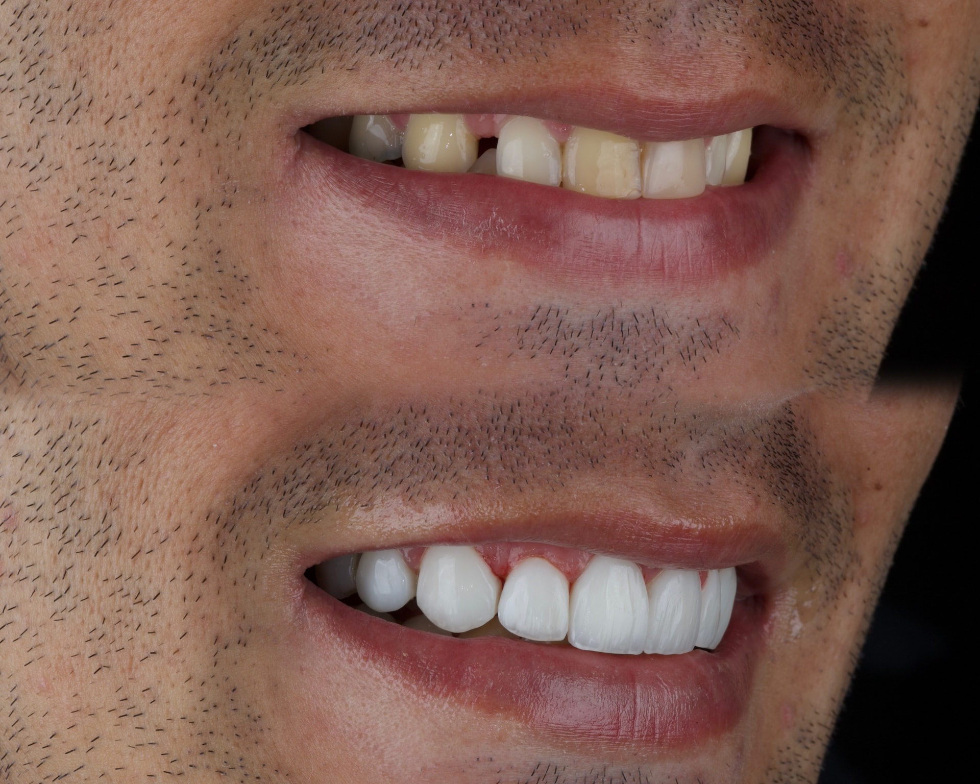 Antes e depois de um caso de facetas de resina, sorriso masculino